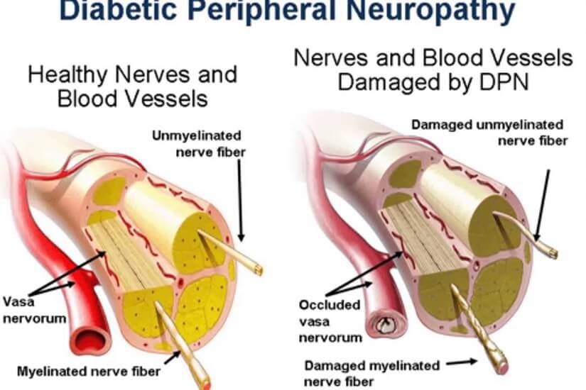 dr-vesa-dijabeticna-polineuropatija